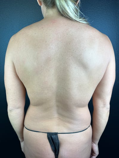 Back (Liposuction) Before & After Gallery - Patient 402435 - Image 1