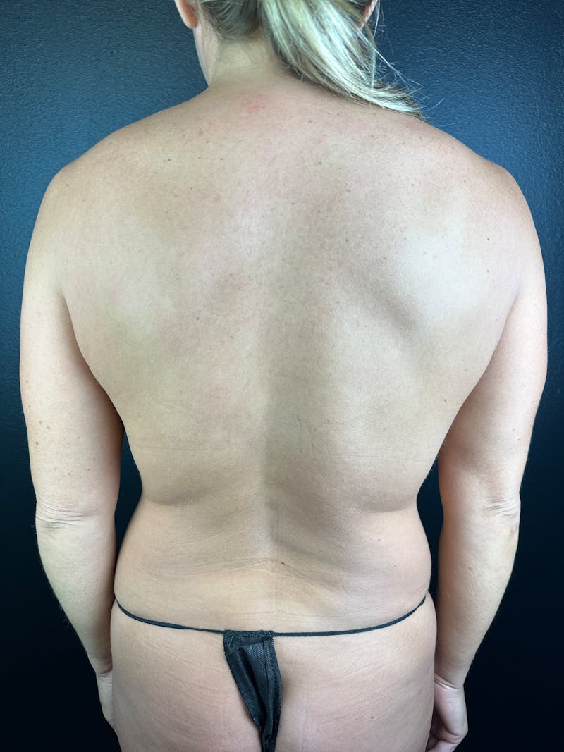 Back (Liposuction) Before & After Gallery - Patient 402435 - Image 1