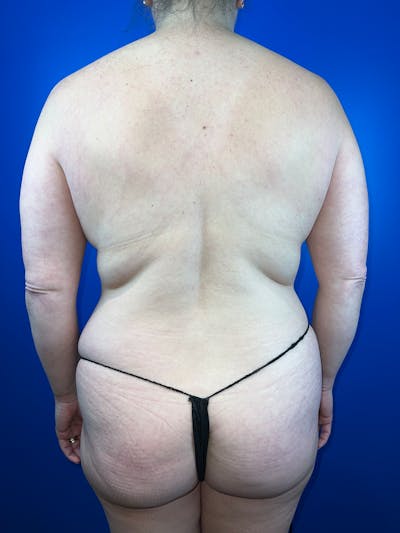 Back (Liposuction) Before & After Gallery - Patient 370163 - Image 1