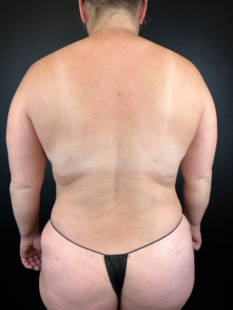 Back (Liposuction) Before & After Gallery - Patient 370163 - Image 2