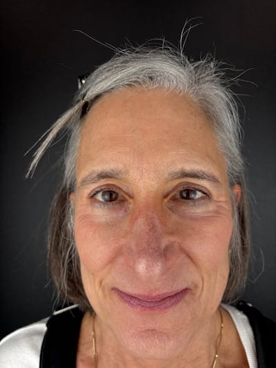 Blepharoplasty Before & After Gallery - Patient 645283 - Image 2