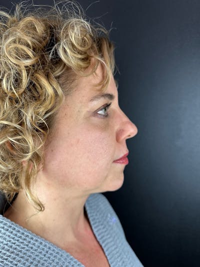 Blepharoplasty Before & After Gallery - Patient 492766 - Image 2