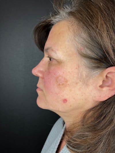 Blepharoplasty Before & After Gallery - Patient 286816 - Image 1
