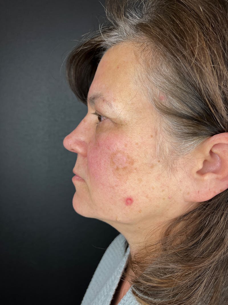 Blepharoplasty Before & After Gallery - Patient 286816 - Image 1