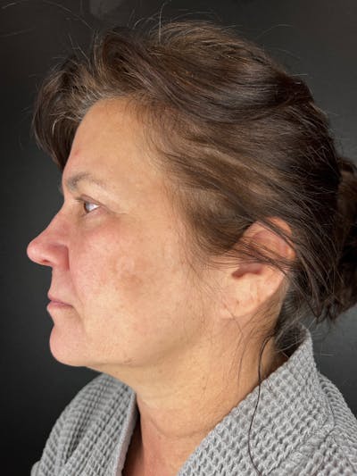 Blepharoplasty Before & After Gallery - Patient 286816 - Image 2