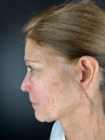 Blepharoplasty Before & After Gallery - Patient 399609 - Image 1