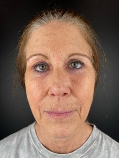 Blepharoplasty Before & After Gallery - Patient 283944 - Image 2