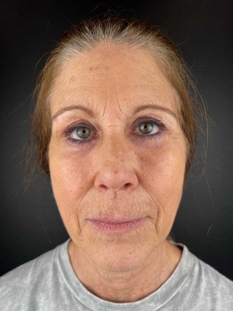 Blepharoplasty Before & After Gallery - Patient 283944 - Image 2