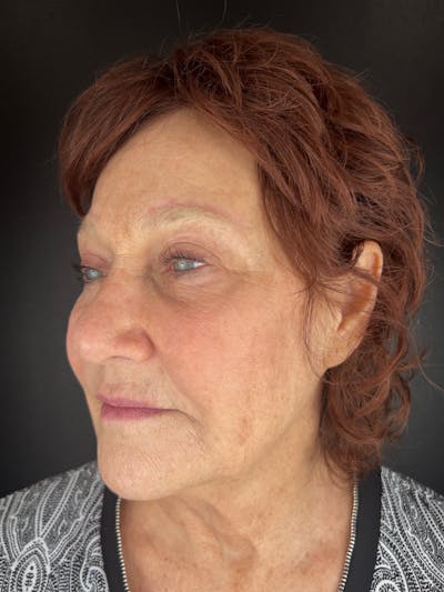 Blepharoplasty Before & After Gallery - Patient 314477 - Image 2