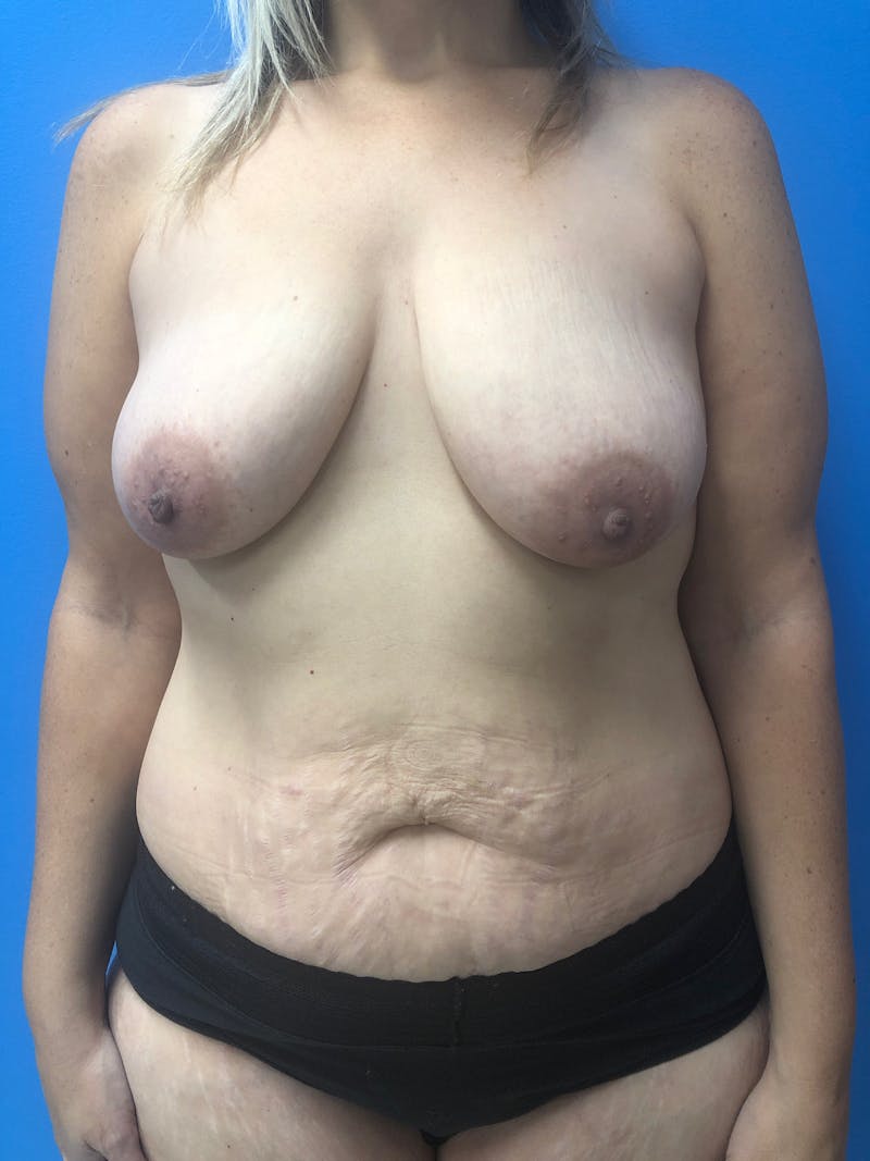 Tummy Tuck Before & After Gallery - Patient 207283 - Image 1