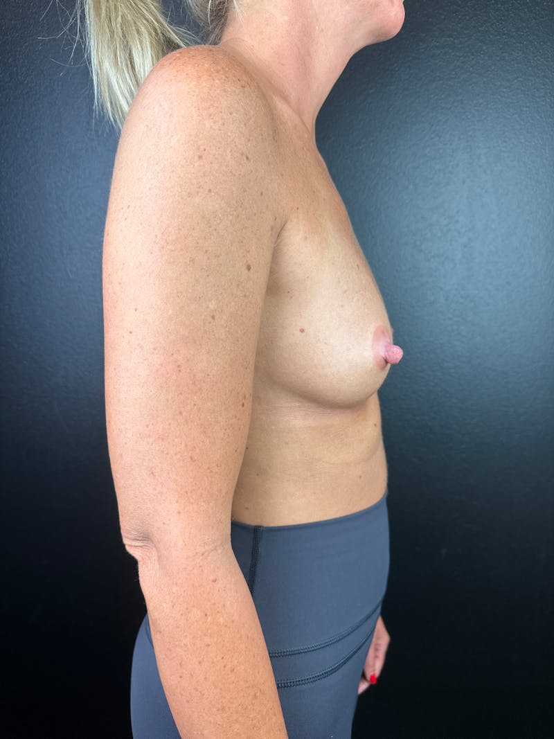 Breast Augmentation Before & After Gallery - Patient 292378 - Image 3