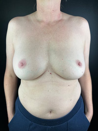 Breast Implant Exchange Before & After Gallery - Patient 238997 - Image 1
