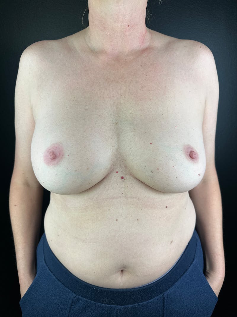Breast Implant Exchange Before & After Gallery - Patient 238997 - Image 1
