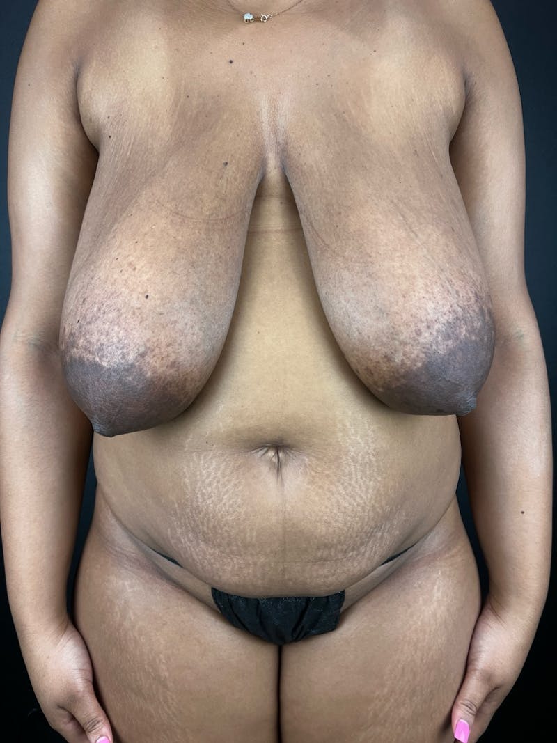 Tummy Tuck Before & After Gallery - Patient 124424 - Image 1