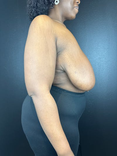 Breast Reduction & Lift Before & After Gallery - Patient 652462 - Image 1