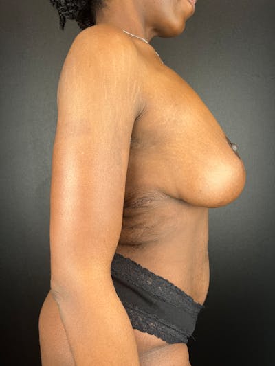 Breast Reduction & Lift Before & After Gallery - Patient 652462 - Image 2