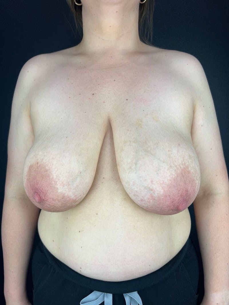 Breast Reduction & Lift Before & After Gallery - Patient 184798 - Image 1