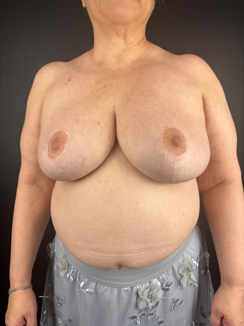 Breast Reduction & Lift Before & After Gallery - Patient 275727 - Image 2