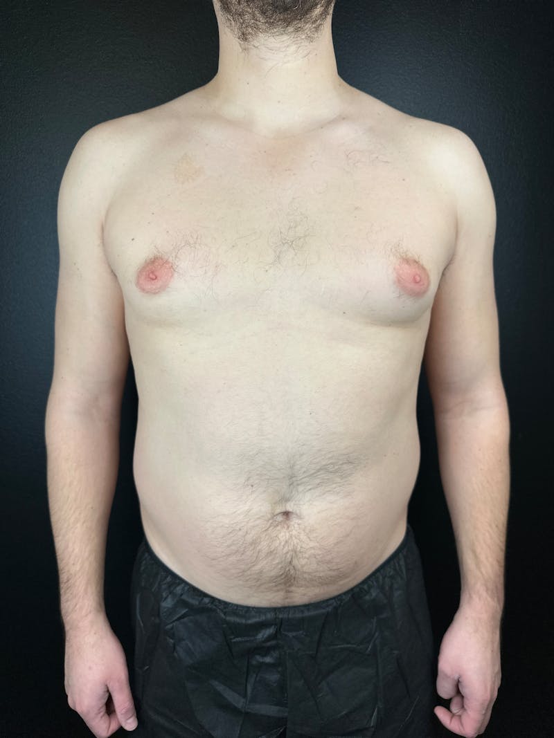 Gynecomastia Before & After Gallery - Patient 425292 - Image 1