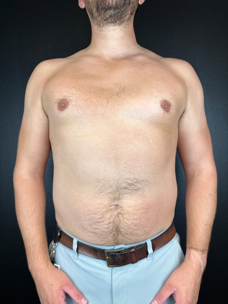Gynecomastia Before & After Gallery - Patient 425292 - Image 2