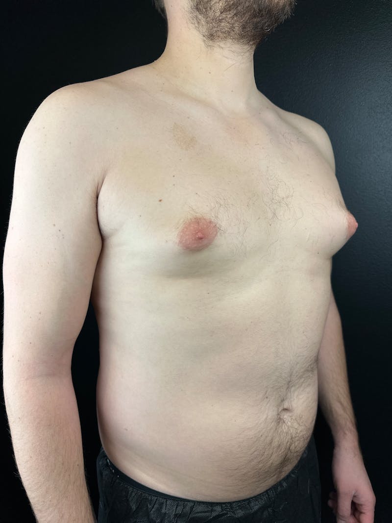 Gynecomastia Before & After Gallery - Patient 425292 - Image 3