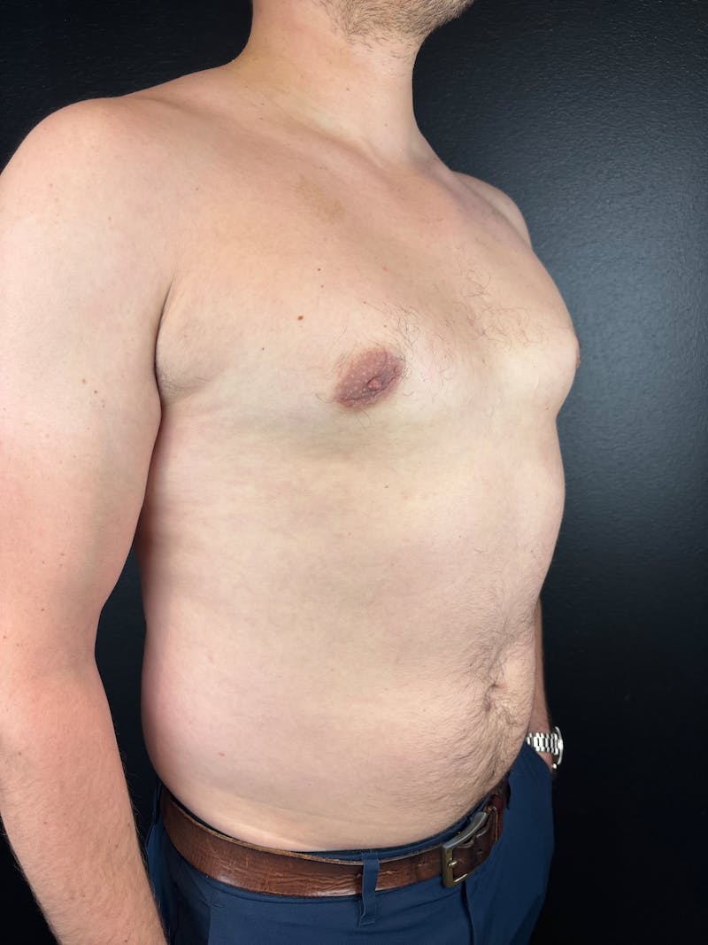 Gynecomastia Before & After Gallery - Patient 425292 - Image 4
