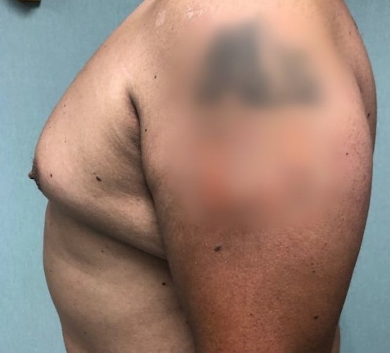 Gynecomastia Before & After Gallery - Patient 152193 - Image 1