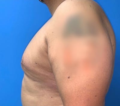 Gynecomastia Before & After Gallery - Patient 152193 - Image 2