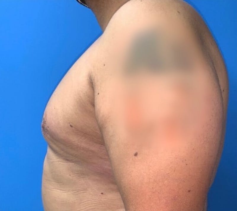 Gynecomastia Before & After Gallery - Patient 152193 - Image 2