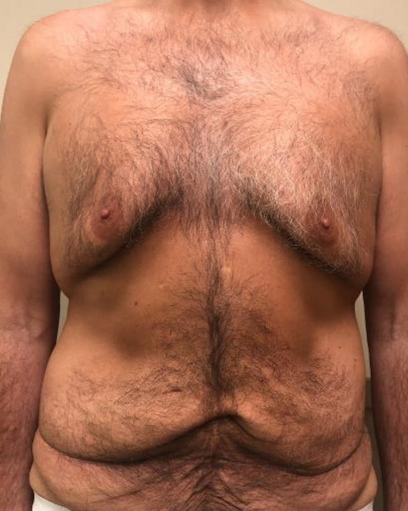 Gynecomastia Before & After Gallery - Patient 251556 - Image 1
