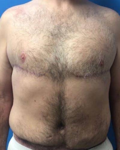 Gynecomastia Before & After Gallery - Patient 251556 - Image 2