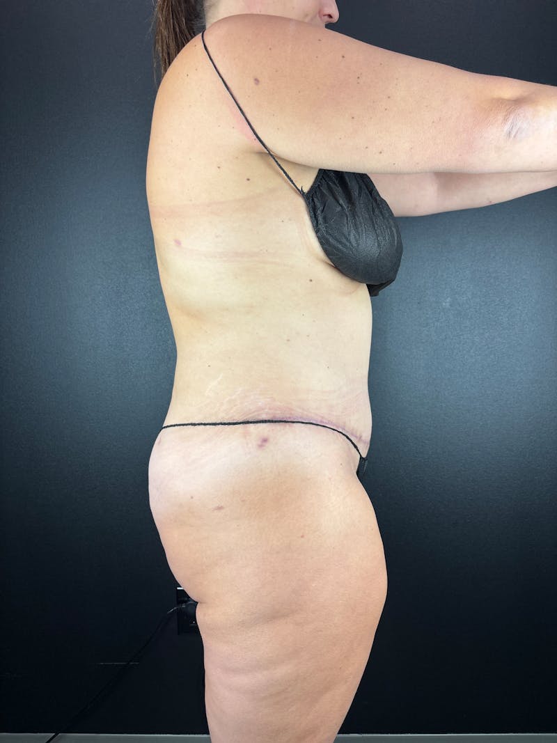 Legs (Liposuction) Before & After Gallery - Patient 372152 - Image 2