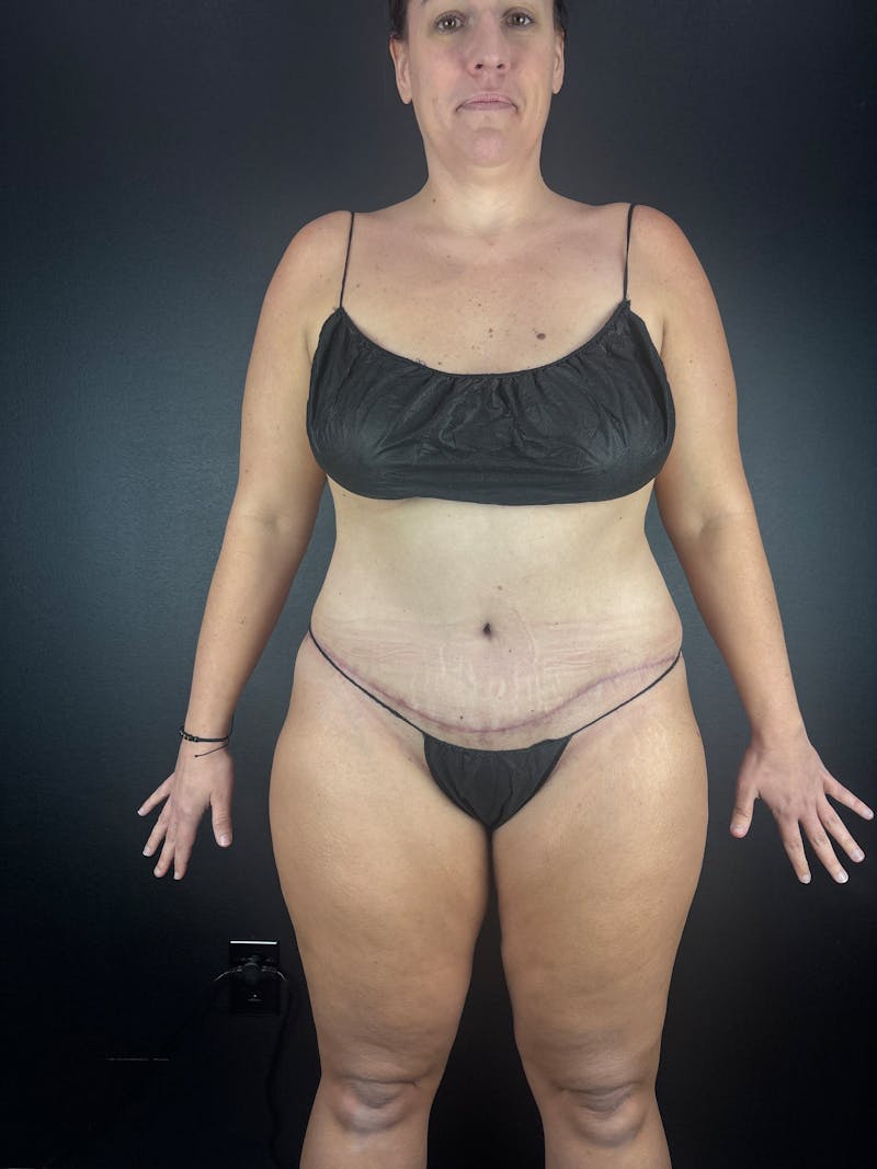 Tummy Tuck Before & After Gallery - Patient 268451 - Image 1