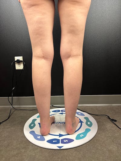 Legs (Liposuction) Before & After Gallery - Patient 483622 - Image 1