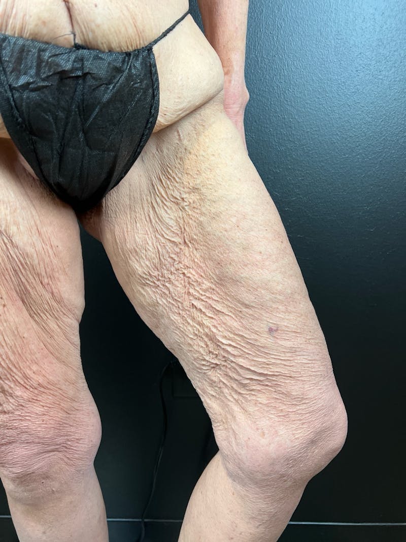 Thigh Lift Before & After Gallery - Patient 833099 - Image 2
