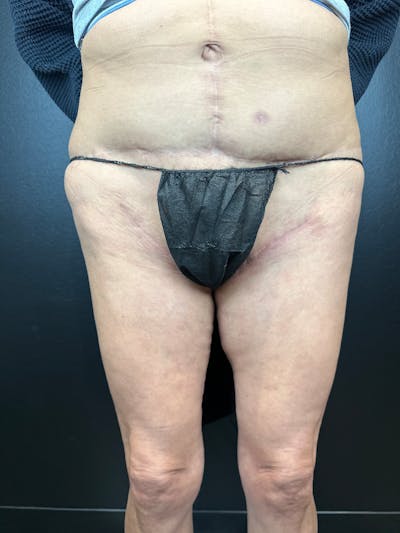 Thigh Lift Before & After Gallery - Patient 374300 - Image 2