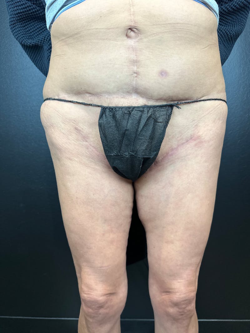 Thigh Lift Before & After Gallery - Patient 374300 - Image 2