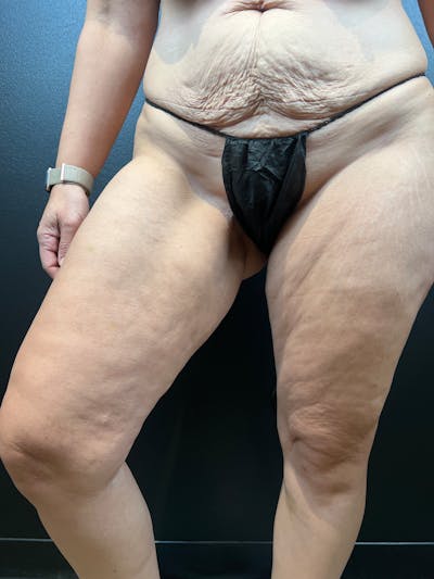Thigh Lift Before & After Gallery - Patient 318802 - Image 1