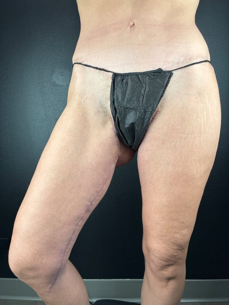 Thigh Lift Before & After Gallery - Patient 318802 - Image 2