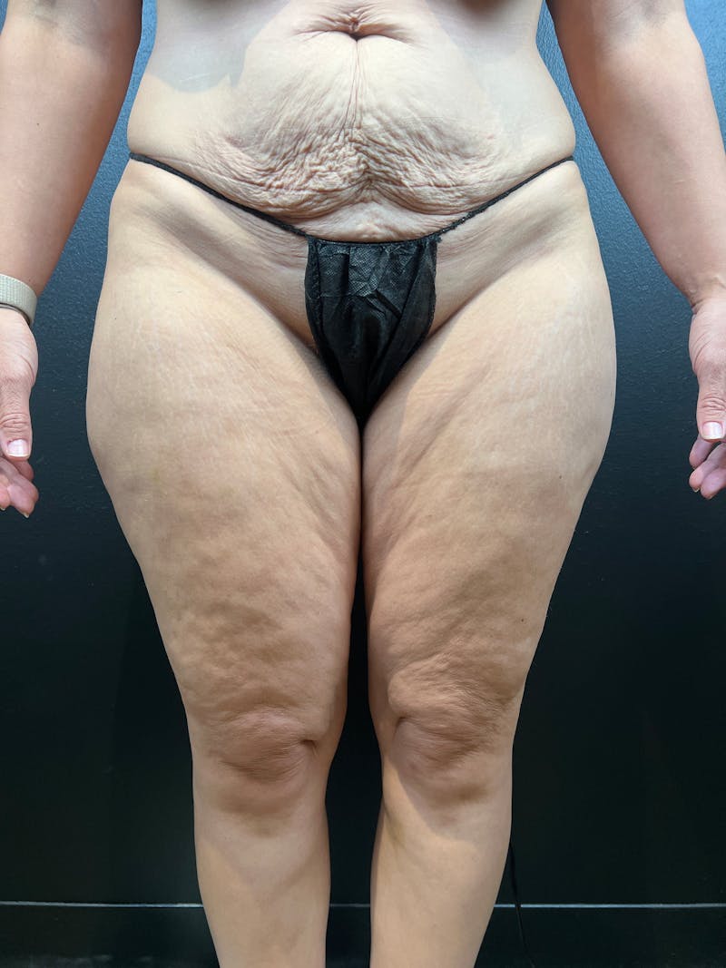 Thigh Lift Before & After Gallery - Patient 318802 - Image 3