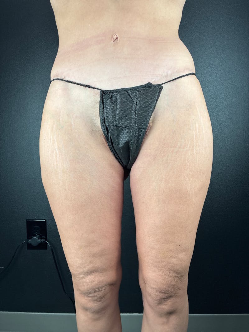 Thigh Lift Before & After Gallery - Patient 318802 - Image 4