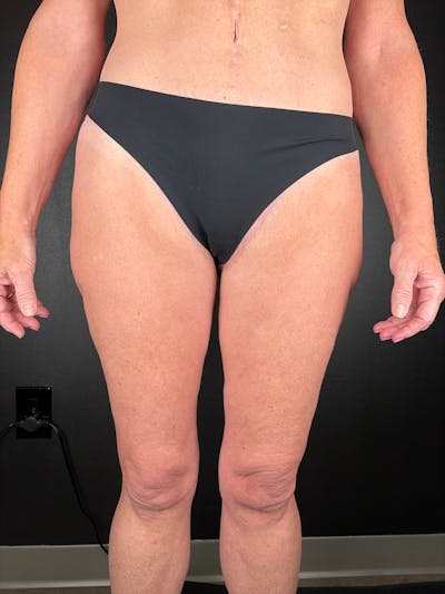 Thigh Lift Before & After Gallery - Patient 765438 - Image 2