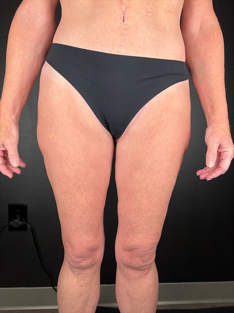 Thigh Lift Before & After Gallery - Patient 765438 - Image 2
