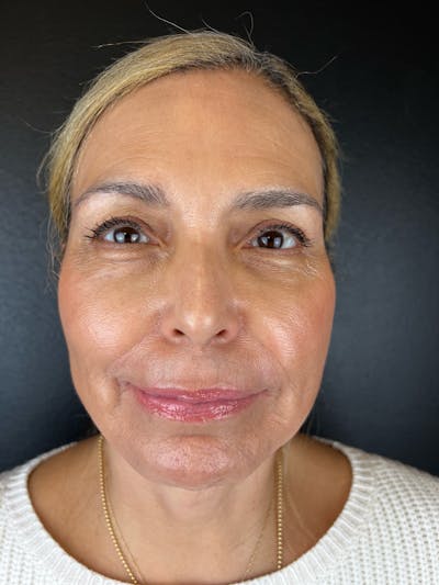 Lip Lift Before & After Gallery - Patient 612378 - Image 1