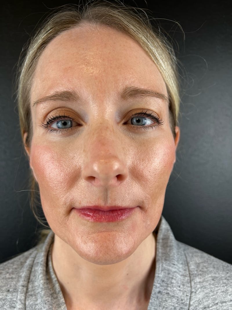 Lip Lift Before & After Gallery - Patient 329839 - Image 1