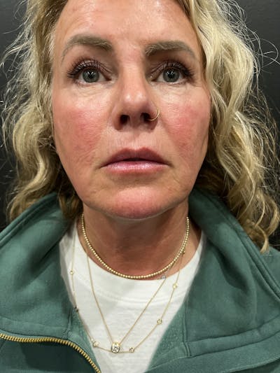 Lip Lift Before & After Gallery - Patient 341087 - Image 2