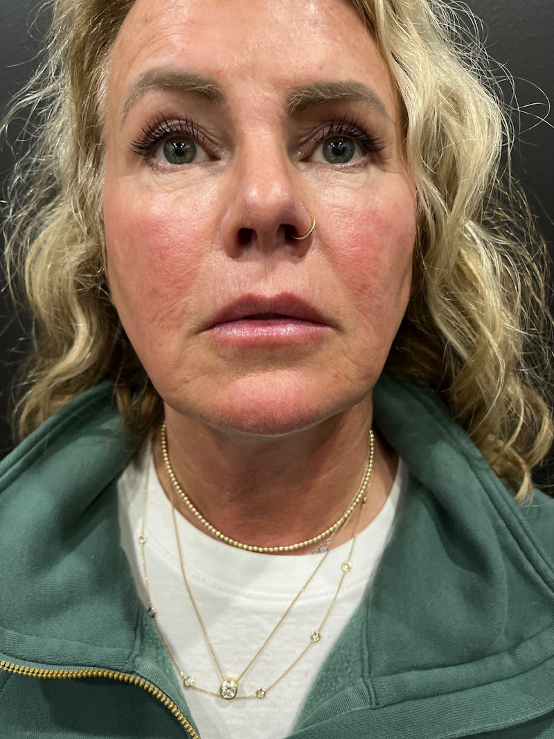 Lip Lift Before & After Gallery - Patient 341087 - Image 2