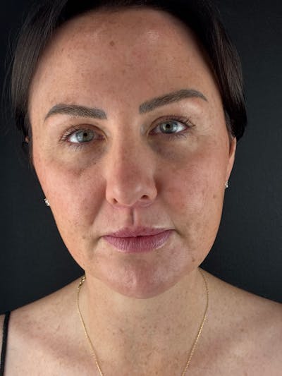Lip Lift Before & After Gallery - Patient 148591 - Image 2