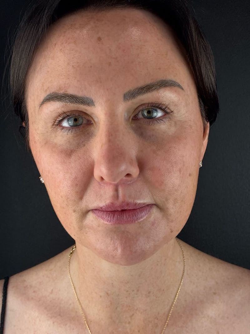 Lip Lift Before & After Gallery - Patient 148591 - Image 2
