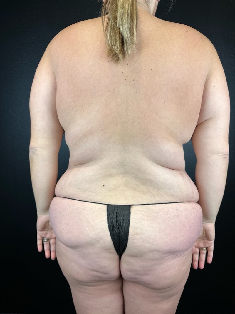 Lower Body Lift Before & After Gallery - Patient 227116 - Image 3